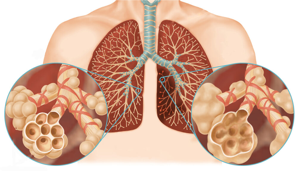 Всемирный день борьбы против хронической обструктивной болезни лёгких