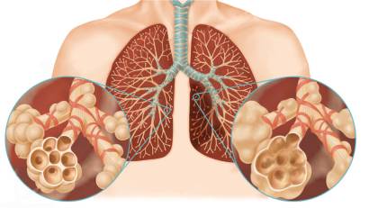 Дүниежүзілік өкпенің созылмалы обструктивті ауруына қарсы күрес күні